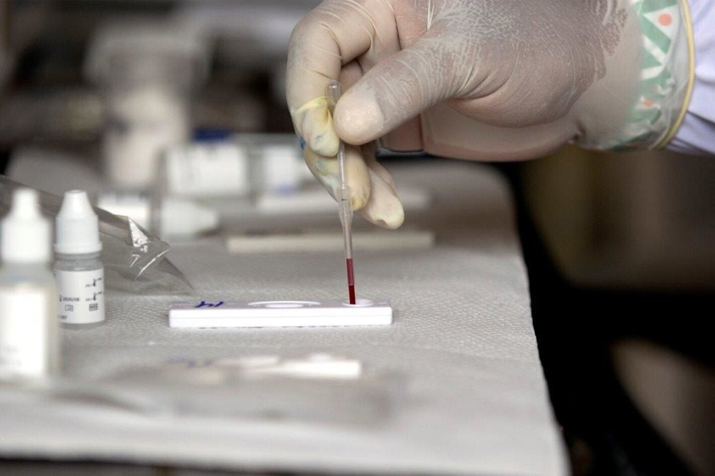 México registra 226 casos probables de hepatitis aguda grave en niños