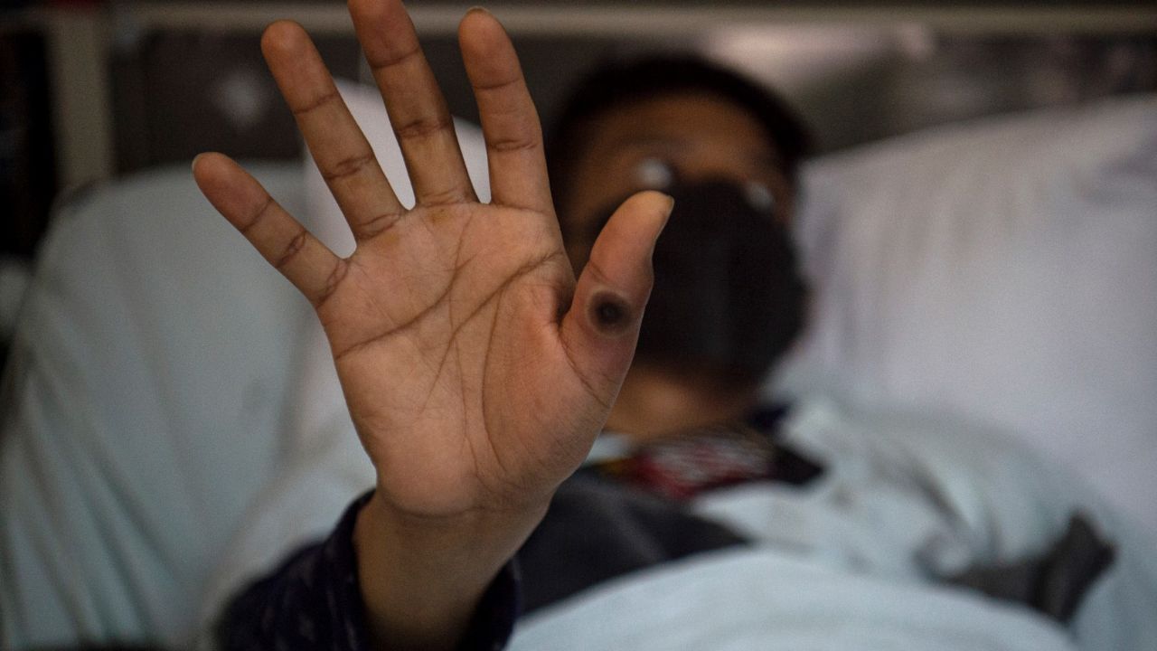 salud-reporta-12-casos-de-viruela-de-mono-en-oaxaca