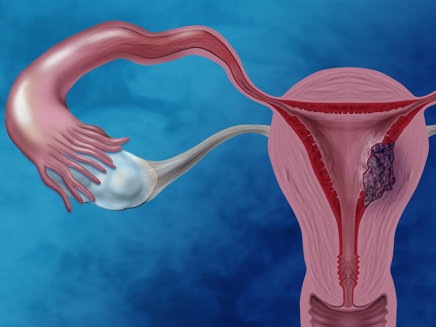 endometrial-cancer-nhgri