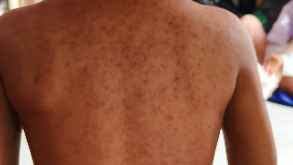 getty-images-sarampion-185855